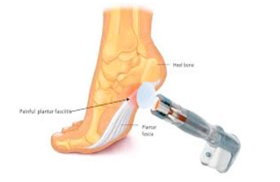 foot pain plantar fasciitis nhs