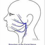 facial palsy