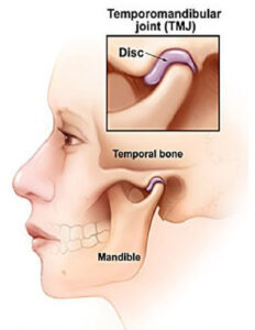 TMJ DYSFUNCTION